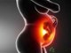 新生儿缺血白如雪：胎儿母体输血综合征
